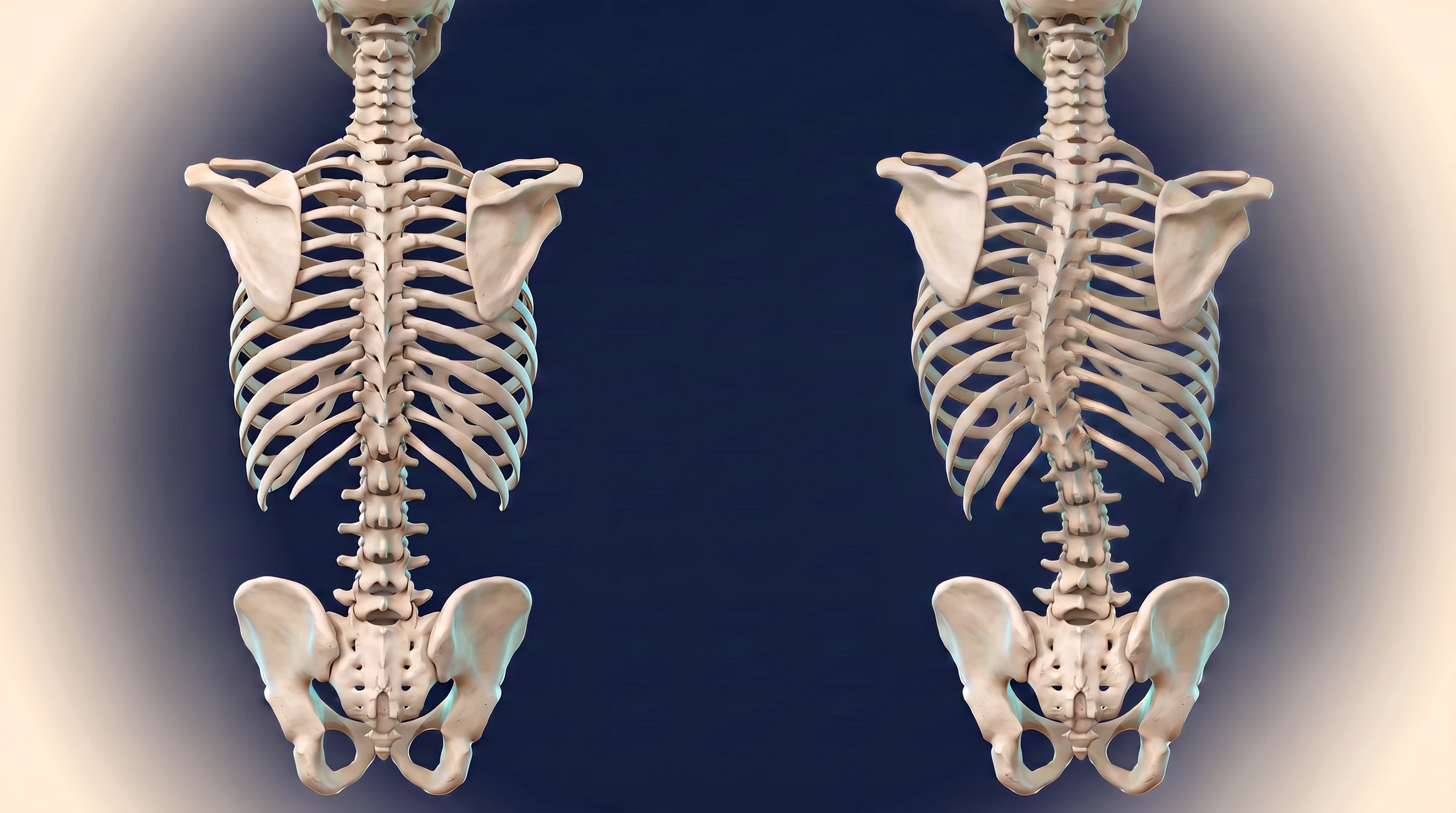 Comparação anatômica posterior entre coluna alinhada e coluna com escoliose toracolombar marcada