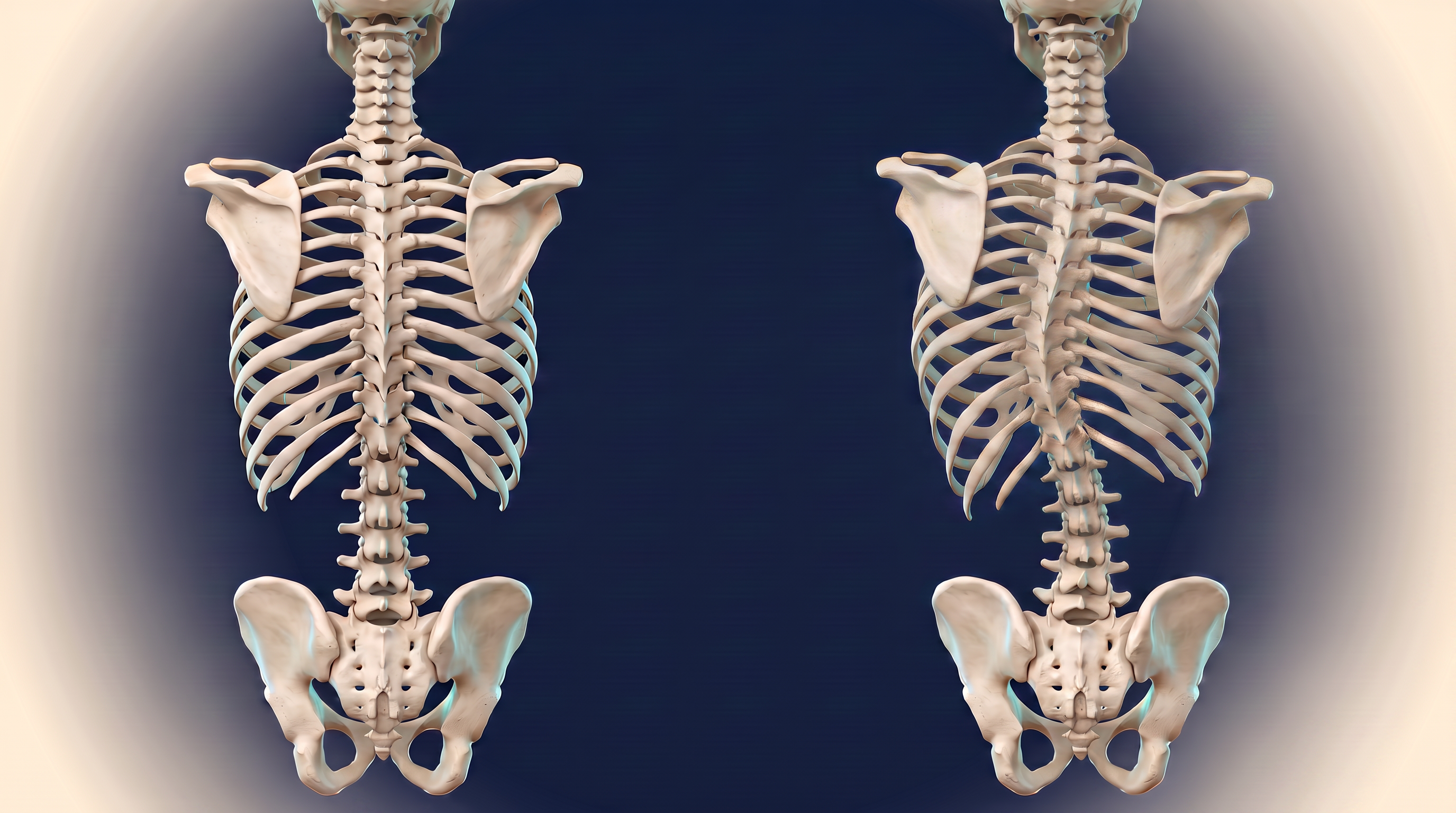 Comparação anatômica posterior entre coluna alinhada e coluna com escoliose toracolombar marcada